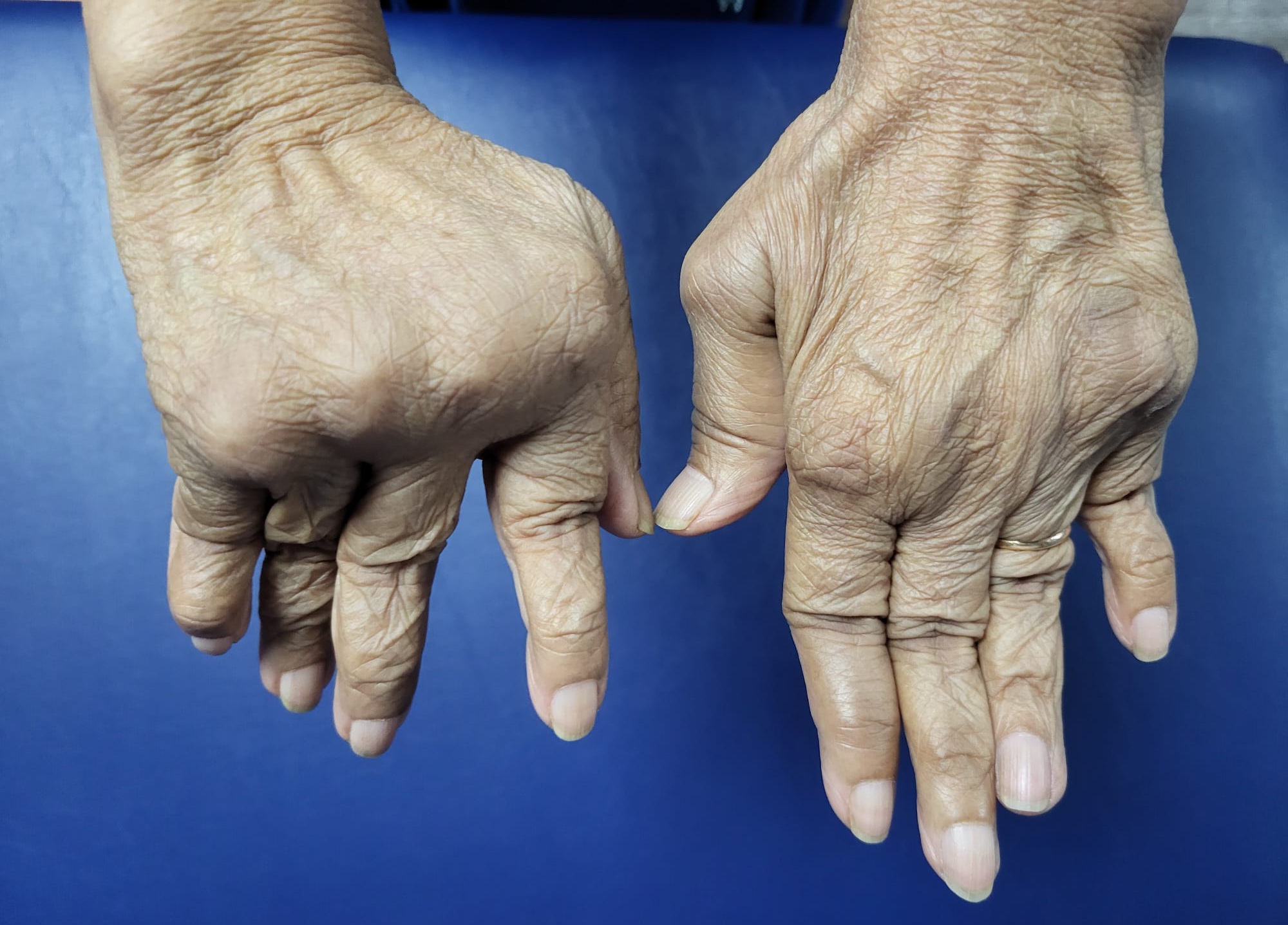 Treatment of an autoimmune inflammatory arthritis