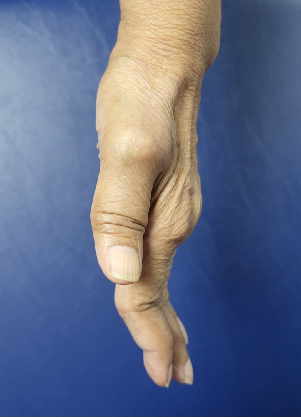 Understanding Arthritis
